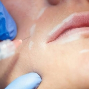 collagen stimulation