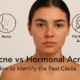 Acne vs Hormonal Acne